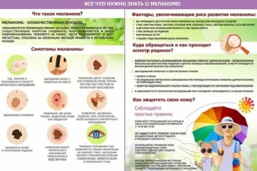 Что нужно знать о меланоме?
